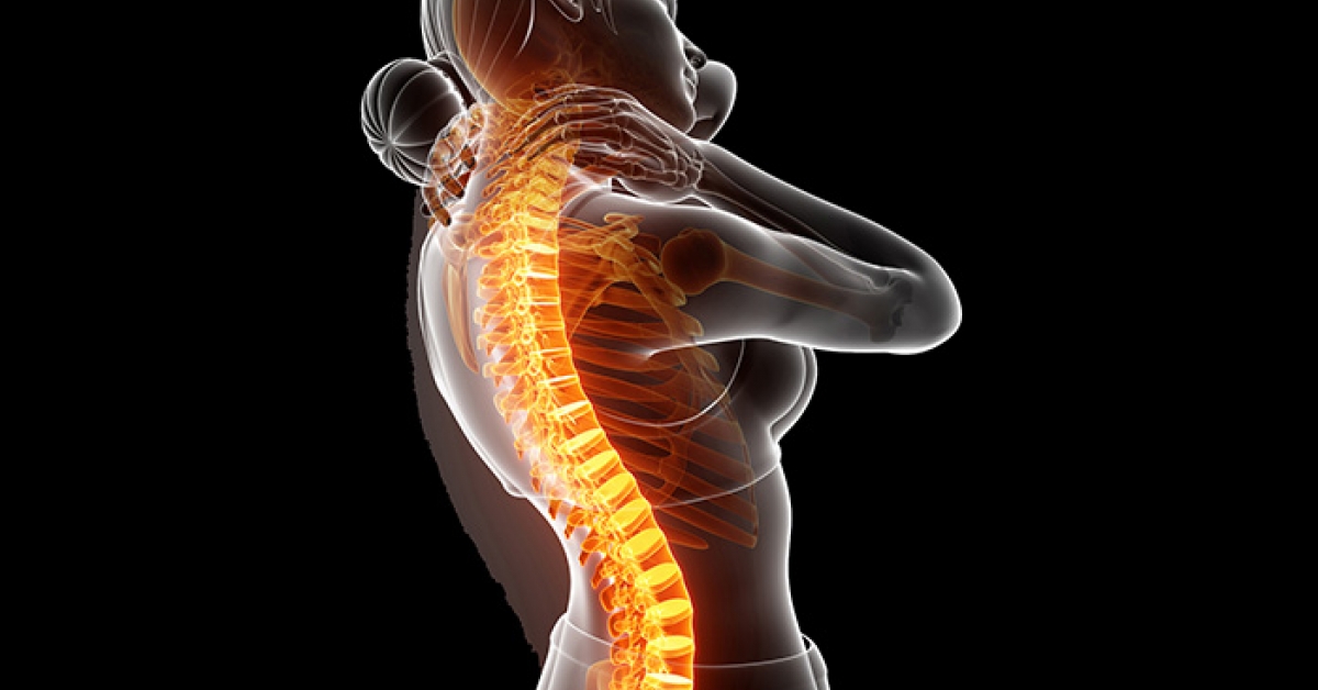 Spinal Cord Stimulation Therapy | RxWiki