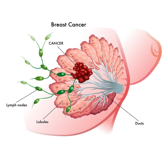 Breast cancer definition