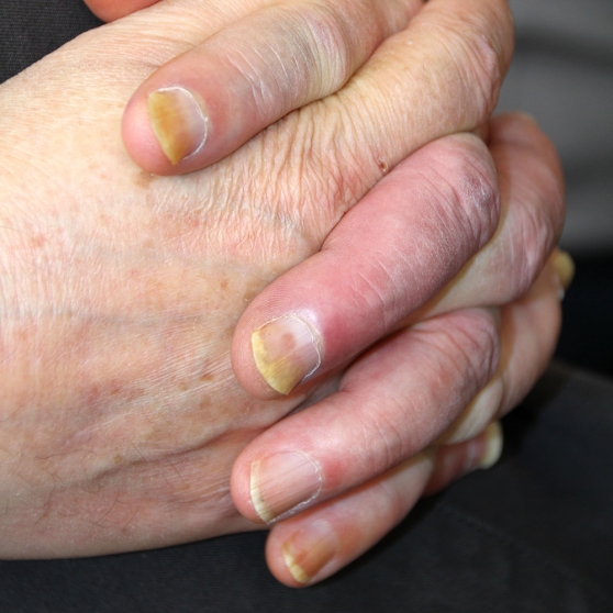 PDF) Yellow Nails, Lymphedema and Chronic Cough: Yellow Nail Syndrome in an  Eight-Year-Old Girl